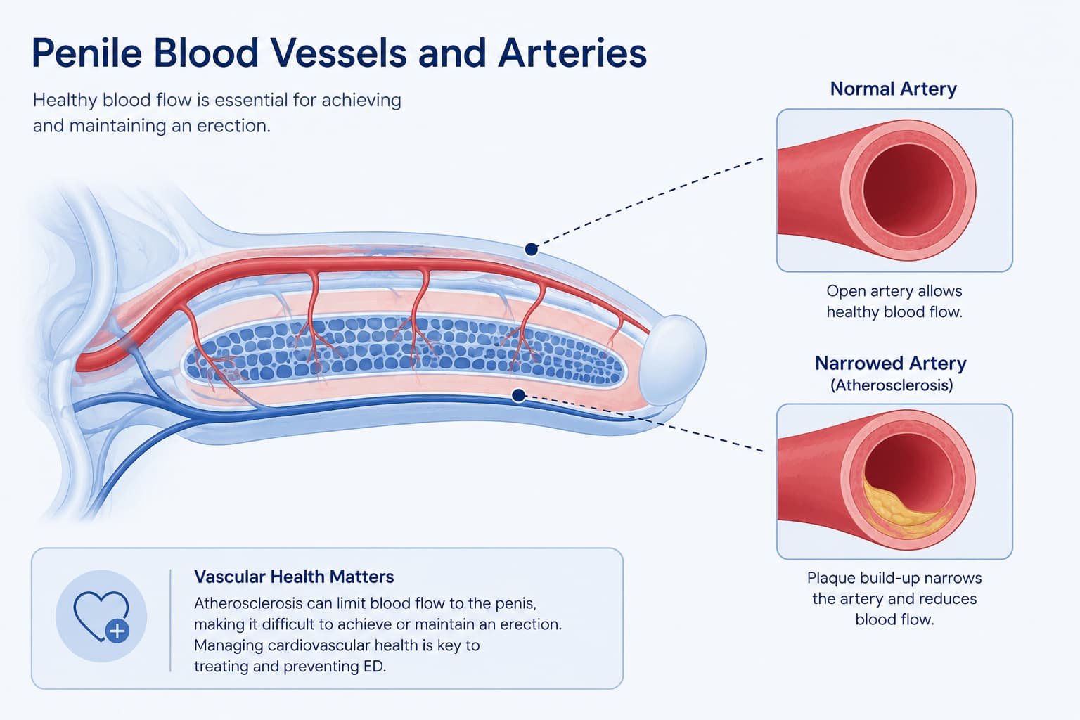 Diagram showing physical causes of ED linked to reduced blood flow