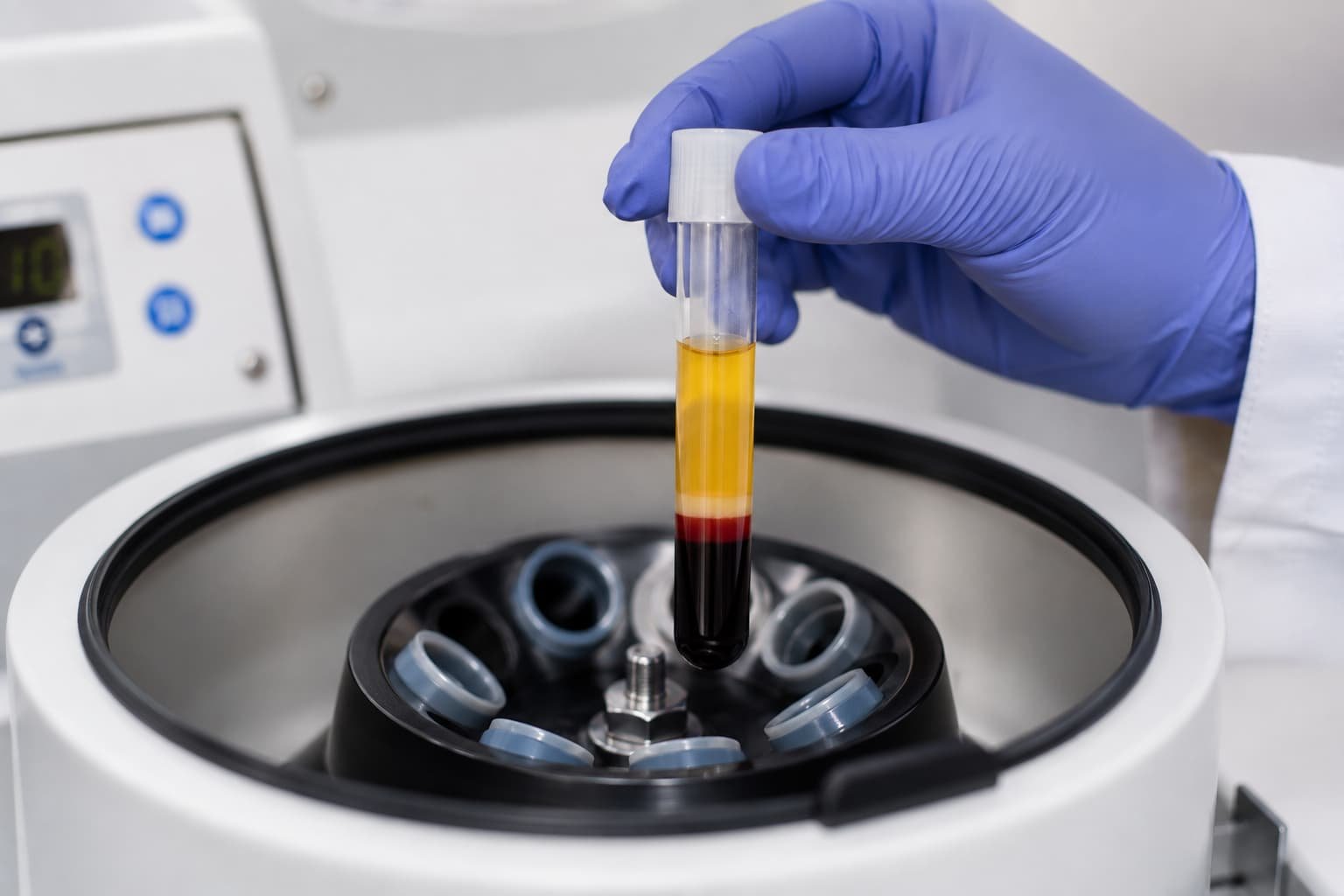 PRP separation process used in P shot treatment