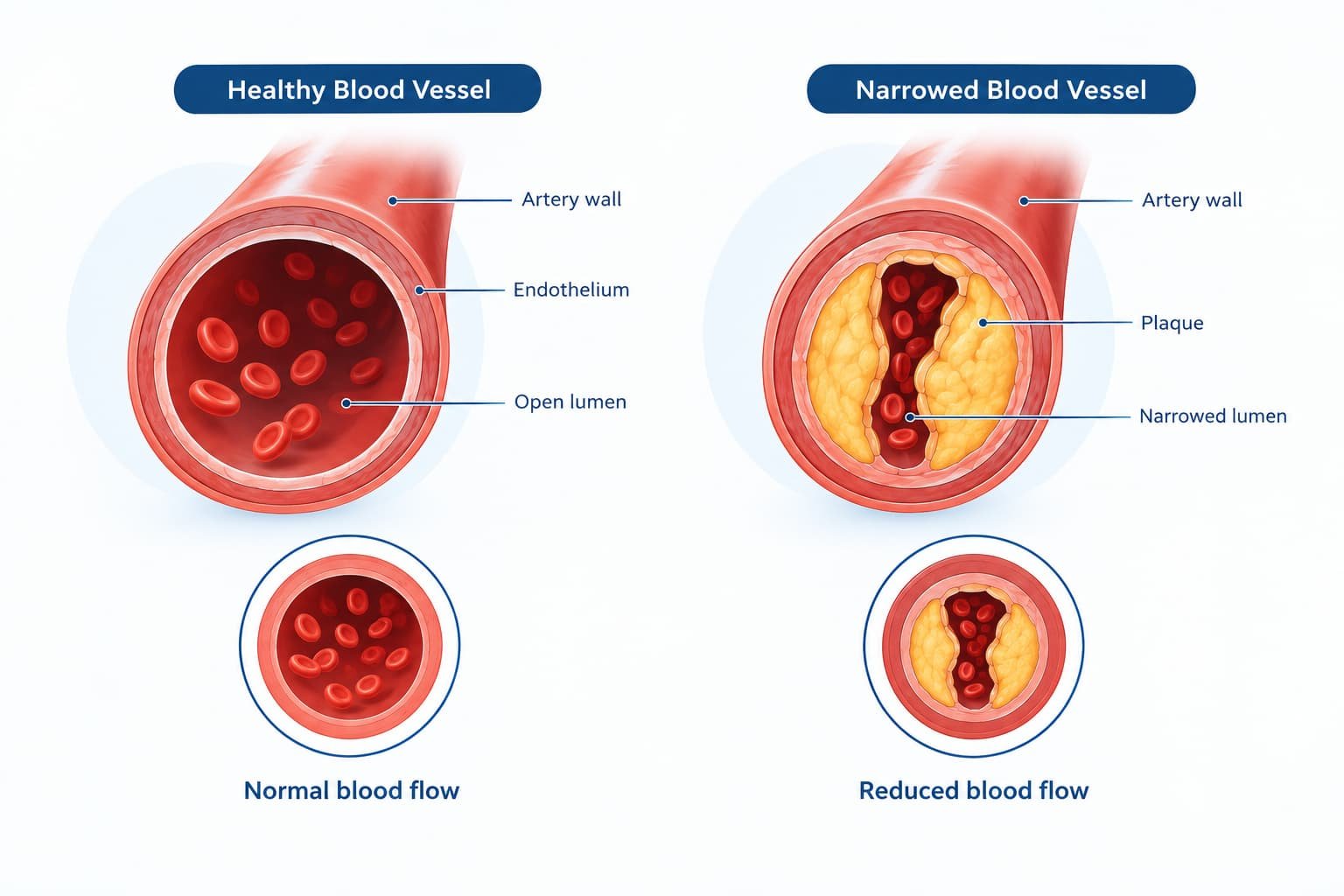 Diagram comparing healthy blood flow with restricted blood flow from vascular disease