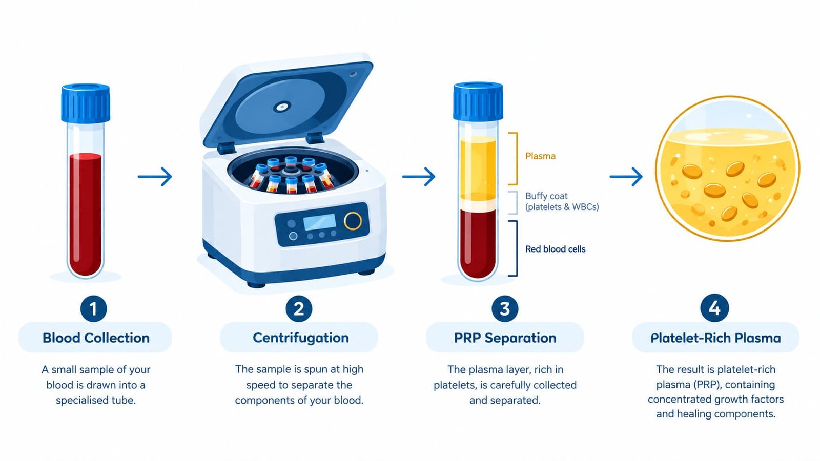 Diagram of a centrifuge separating platelet-rich plasma from a blood sample