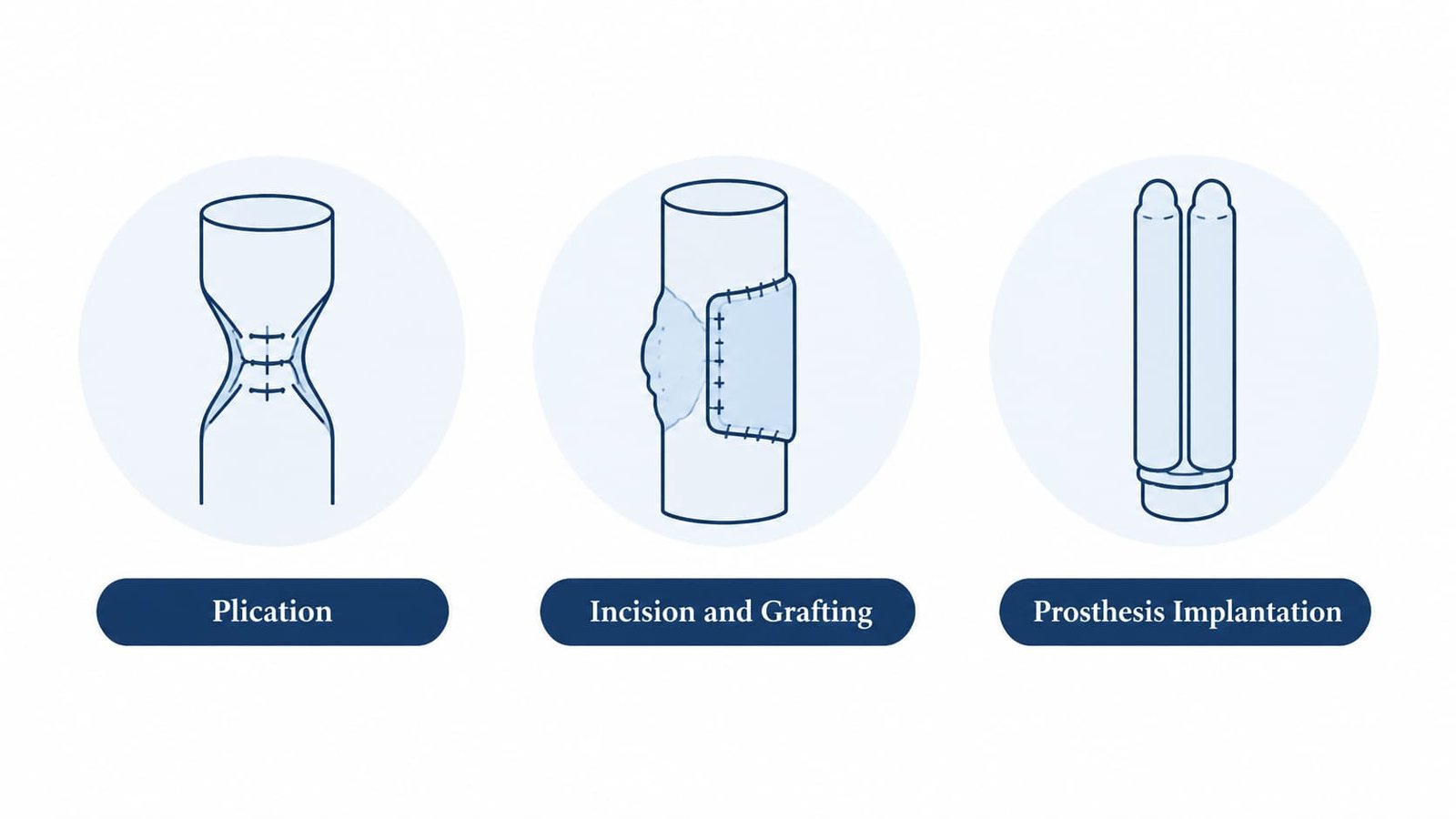 Icons comparing plication, grafting and prosthesis as surgical Peyronie's disease treatment options