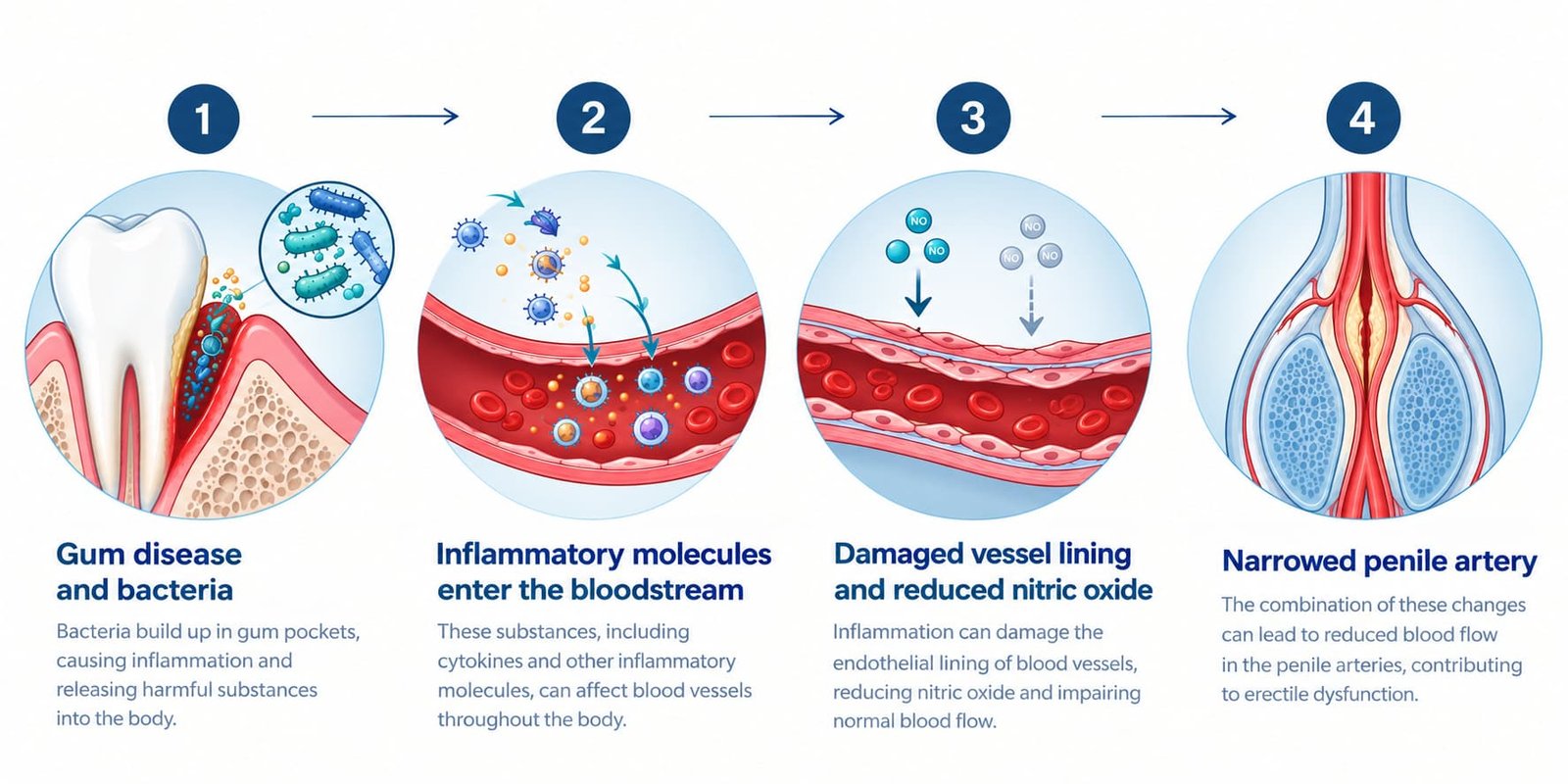 Four-step diagram of how gum inflammation may reduce nitric oxide and penile blood flow